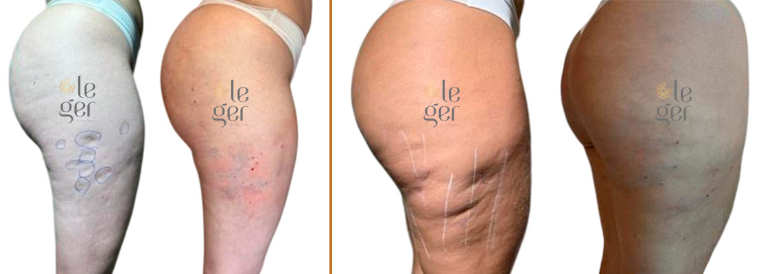 Antes e depois do tratamento para celulite GoldIncision na Clínica Leger