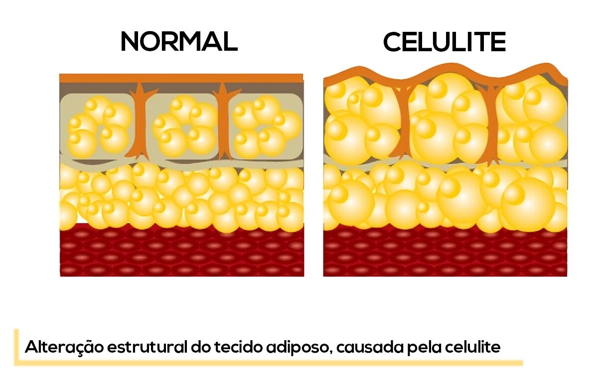 Comparação entre pele normal e pele com celulite mostrando alterações estruturais do tecido adiposo