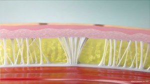 Ilustração médica da pele em corte transversal, mostrando os septos fibrosos brancos puxando a pele para baixo e células de gordura amarelas se projetando para cima, criando uma superfície irregular que gera a celulite.